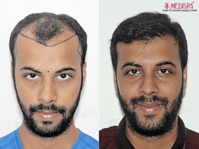 hair transplant india